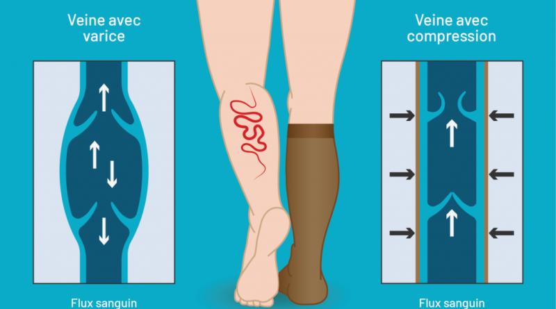 comment Prévenir les varices