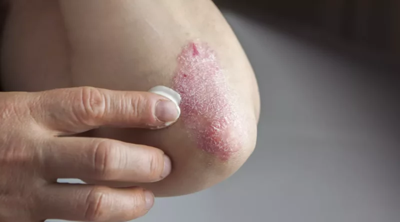 remede psoriasis