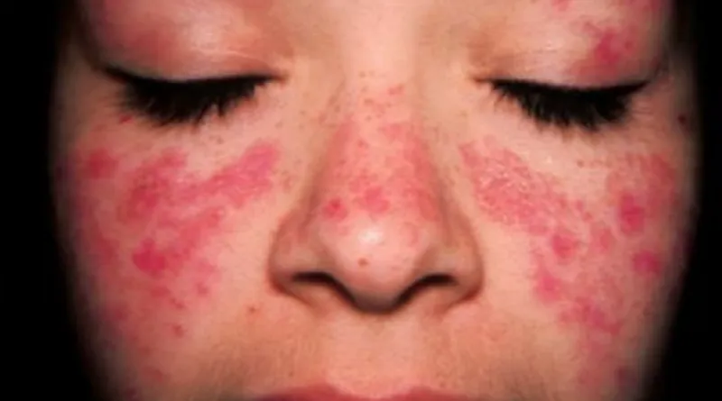 lupus