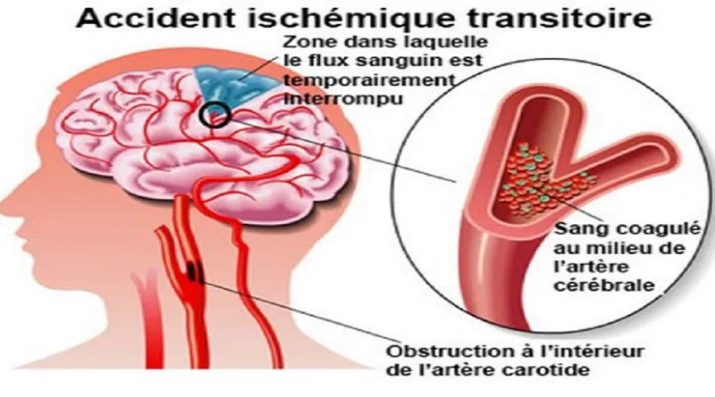 Accès ischémiques transitoires