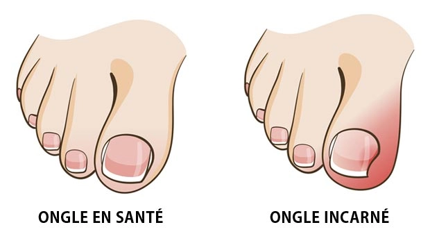 ongle incarné