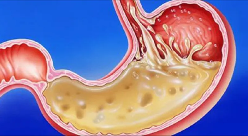 La bactérie Helicobacter pylori