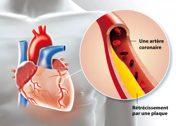 CAR-angine de poitrine_0.jpg