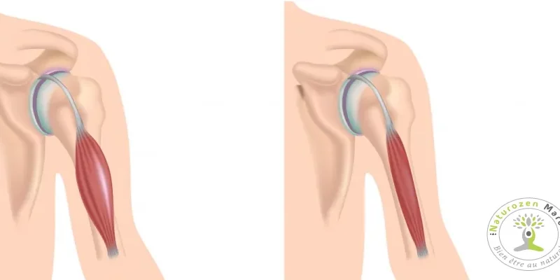 dystrophie-musculaire