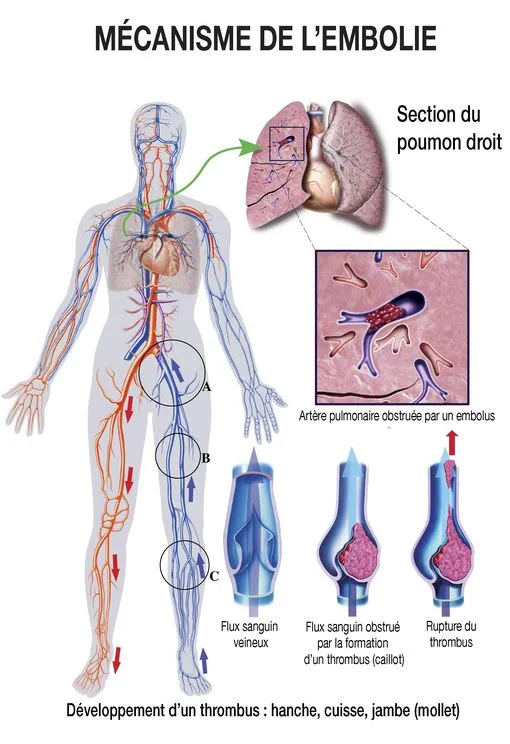 embolie-pulmonaire-1