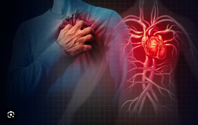 infarctus du myocarde