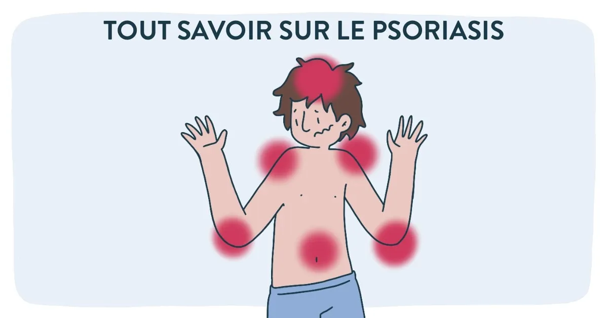 tout-savoir-sur-le-psoriasis-min (1)