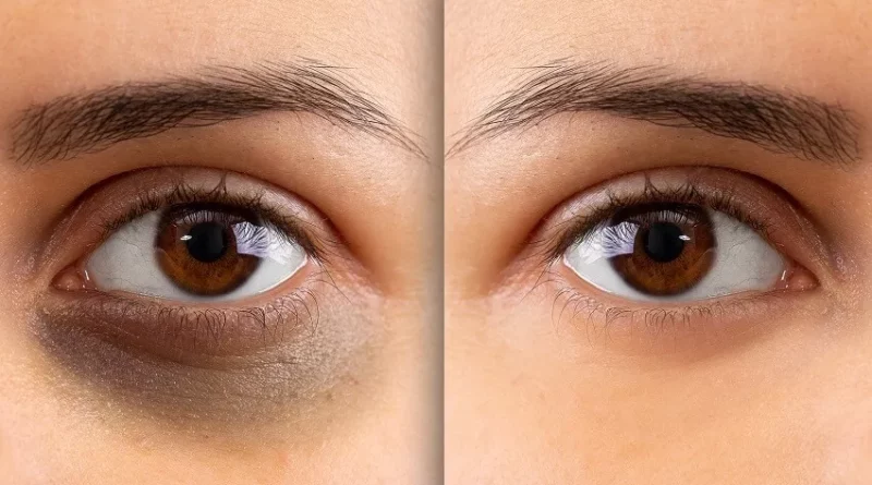 Remède naturel yeux cernés