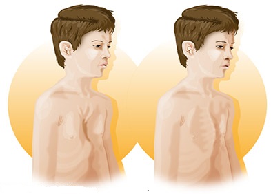 Le syndrôme de Marfan