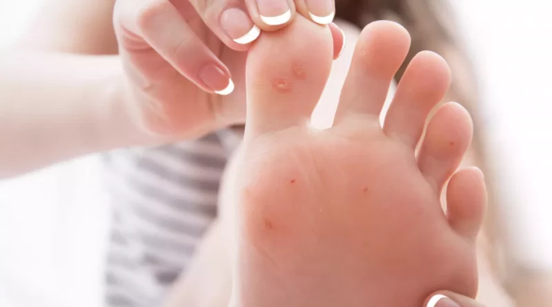remèdes cors aux pieds