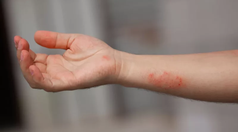 dartres et eczema
