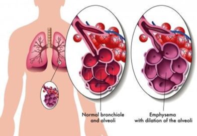 Découvrez des solutions naturelles pour améliorer la respiration et réduire les symptômes de l'emphysème grâce à des plantes, huiles essentielles et bonnes habitudes.