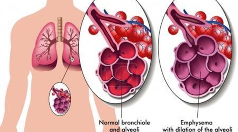 Découvrez des solutions naturelles pour améliorer la respiration et réduire les symptômes de l'emphysème grâce à des plantes, huiles essentielles et bonnes habitudes.