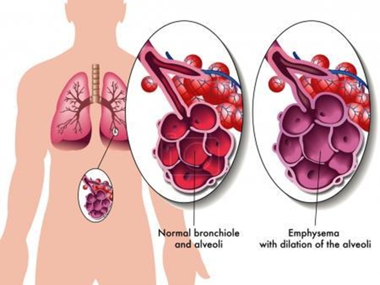Découvrez des solutions naturelles pour améliorer la respiration et réduire les symptômes de l'emphysème grâce à des plantes, huiles essentielles et bonnes habitudes.