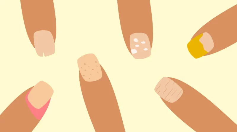 5 cas où les problèmes d’ongles sont symptômes de maladies