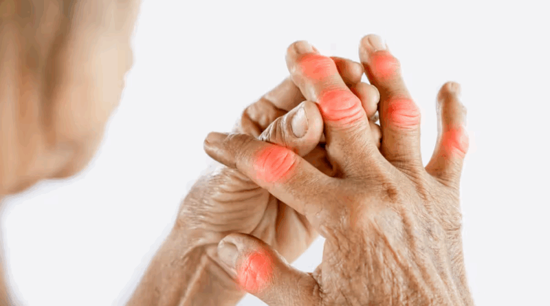 Remèdes naturels pour l'arthrite